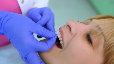 How Long Does It Take To Have Dental Veneers?