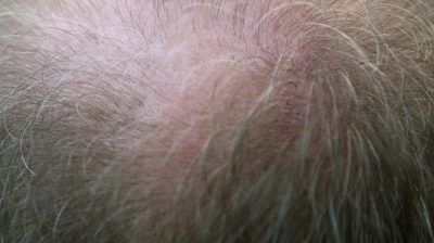 wellness-force-hair-loss